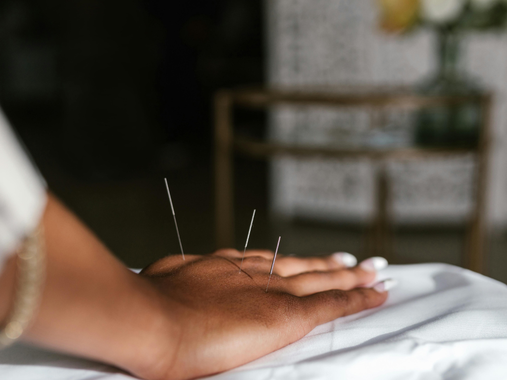 Traditional Chinese acupuncture